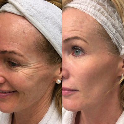 VÉRÉA – Ryppyihin, joita piilotat. Ja tuotteisiin, jotka valehtelivat